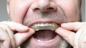 پروتز دهان برای درمان دندان قروچه