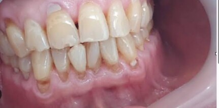 bruxism دندان قروچه